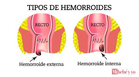 hemorroides infografia