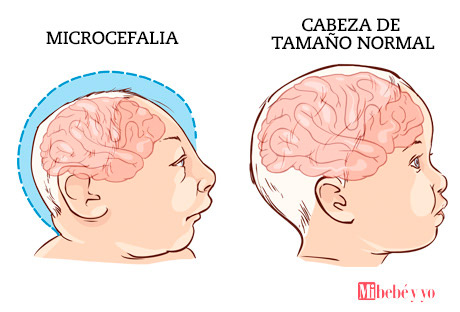 microcefalia infografia