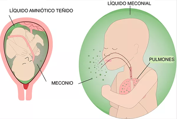 L Quido Amni Tico Meconial O Te Ido Peligroso Para El Feto