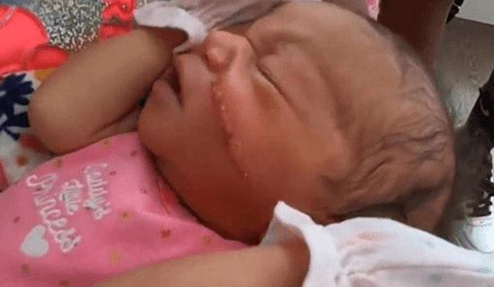 Bebé con corte en la cara por cesárea