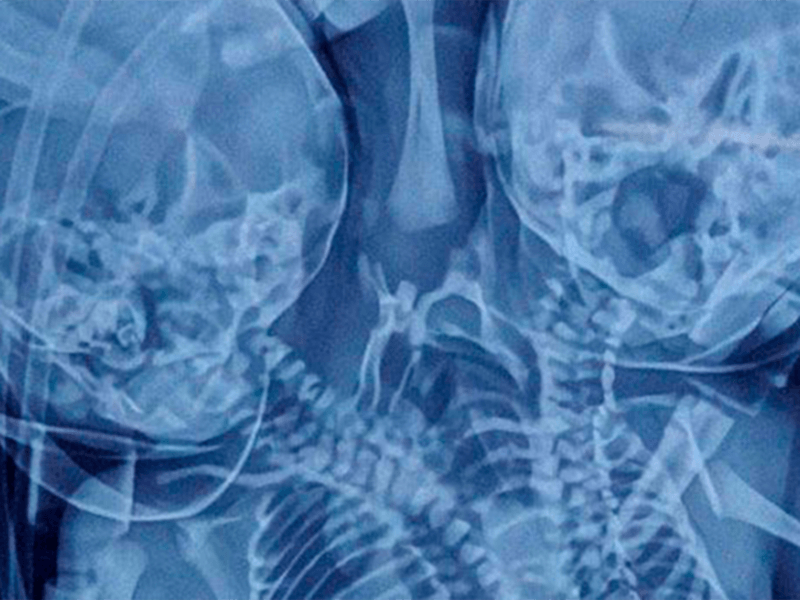 Radiografía del bebé con dos cabezas