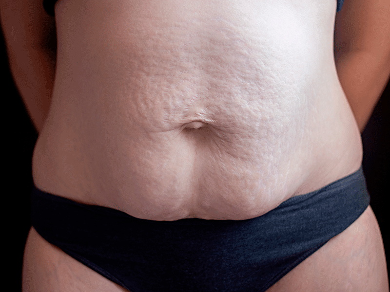 barriga-despues-dar-a-luz