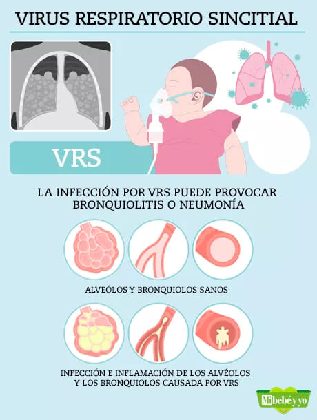 virus-respiratorio-sincitial