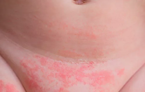 piel-con-dermatitis-panal