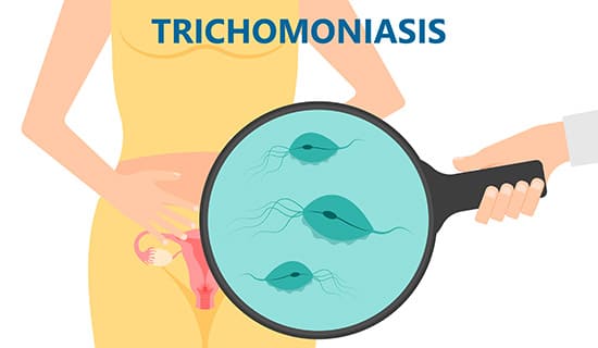 Infecciones_tricomoniasis