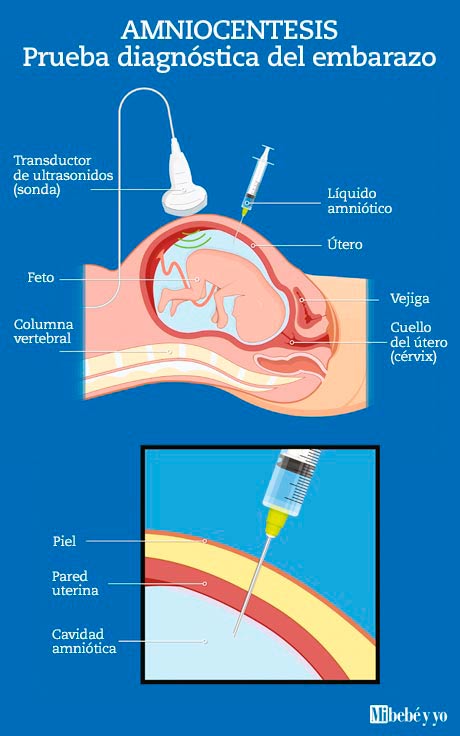 amniocentesis infografia