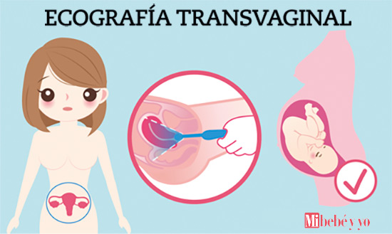 eco transvaginal infografia