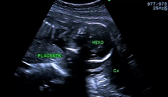 ecografia-placenta-metodo-ramzi