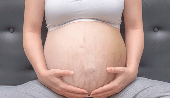embarazada con estrias
