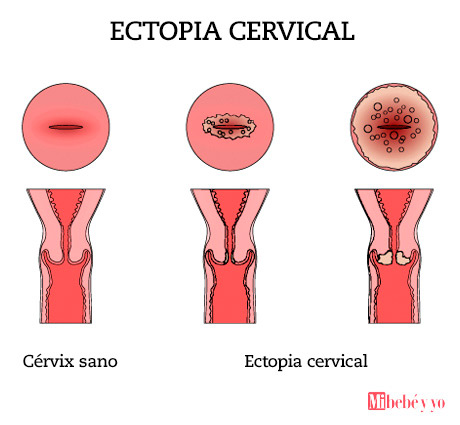 erosion cervical infografia