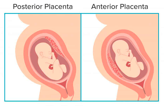 placenta posterior vs placenta anterior