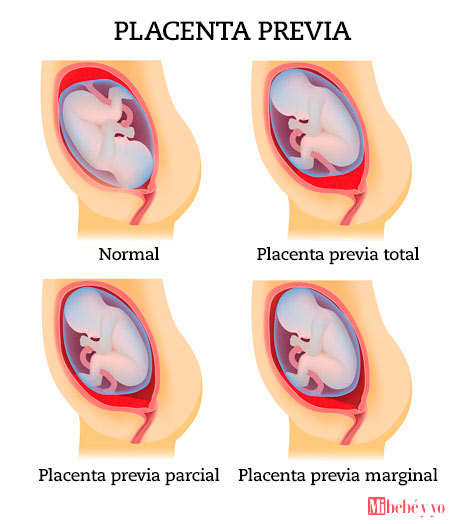 placenta previa infografia