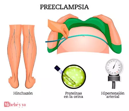 Preeclampsia infografía