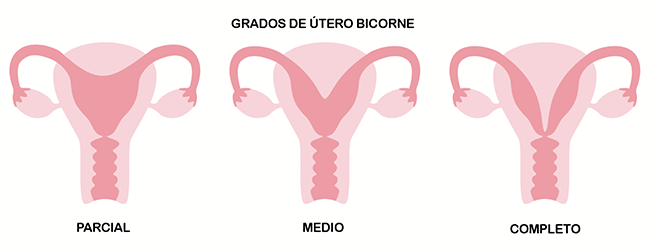utero bicorne infografia