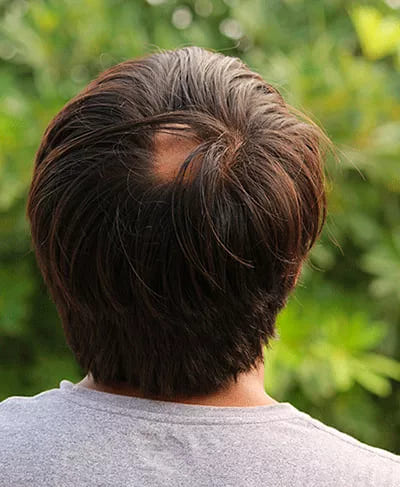alopecia-areata-coronilla