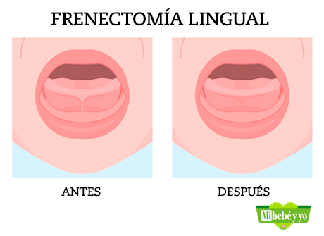 frenectomia lingual