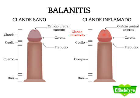 glande inflamado balanitis infografia