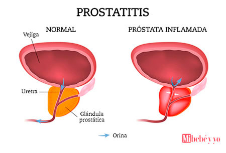 prostatitis infografia