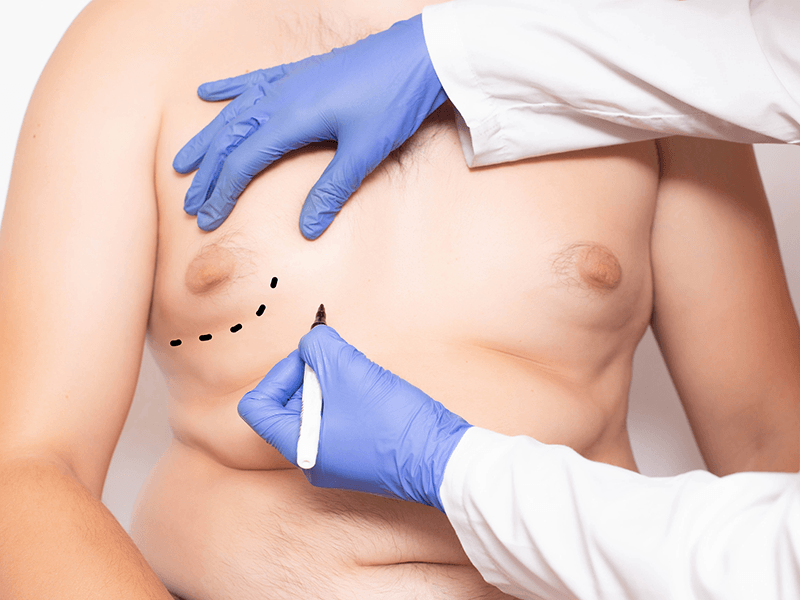 Cirugía de pechos en hombres