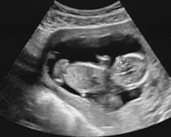 ecografia bebe semana 14