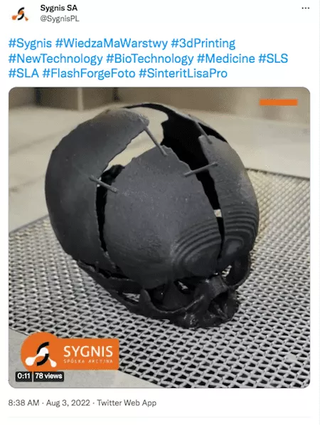 Salvan la vida de un bebé al replicar un modelo 3D de su cráneo
