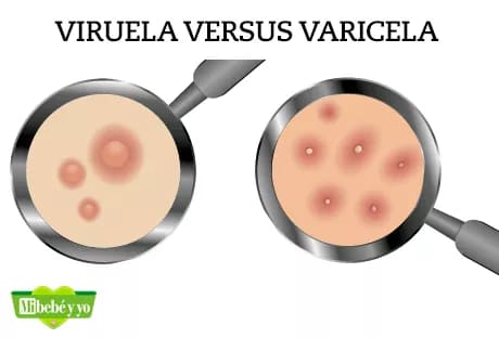 diferencias-viruela-varicela