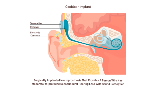 implante-coclear-desarrollo-infantil-esquema