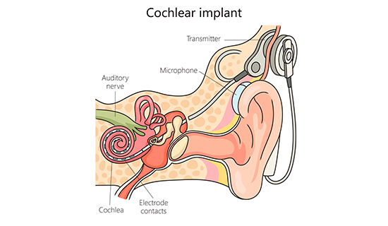 imss-otorgara-implantes-cocleares-ninos-adolescentes-discapacidad-auditiva-implante