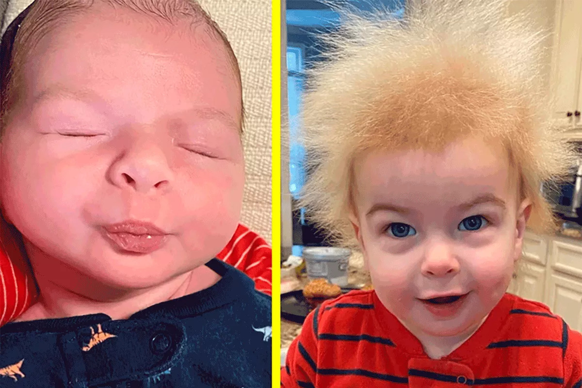 pelo impeinable sindrome viral