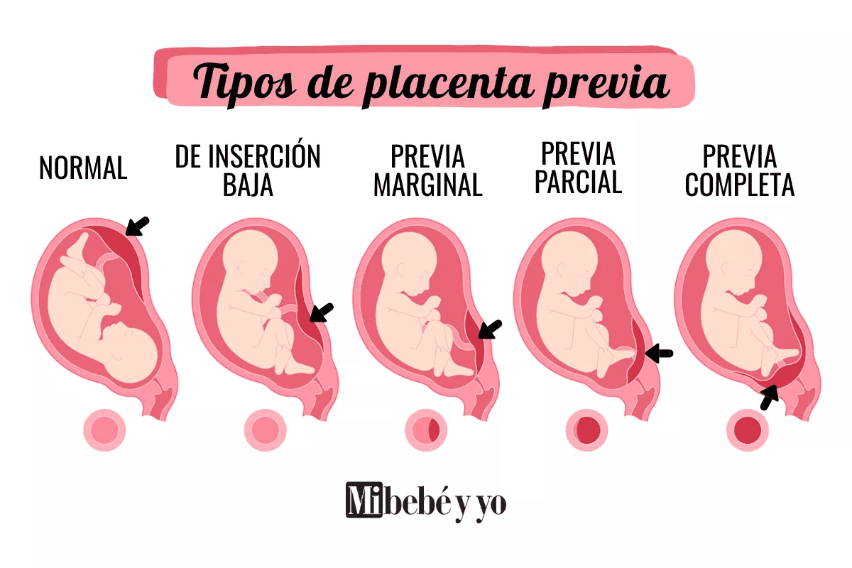 tipos_placenta