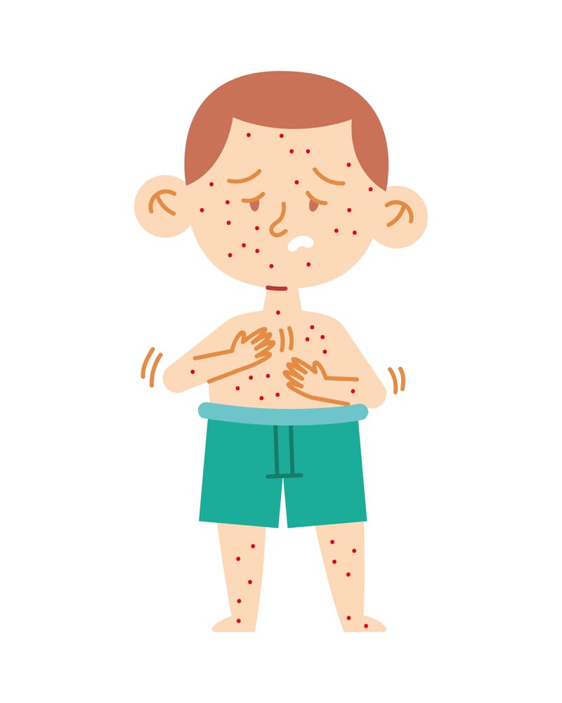 brote-sarampion-mexico-como-proteger-prevenir-contagios-dibujo