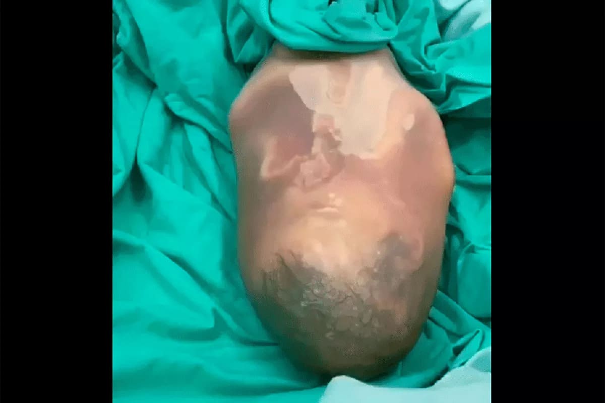 video parto velado bolsa