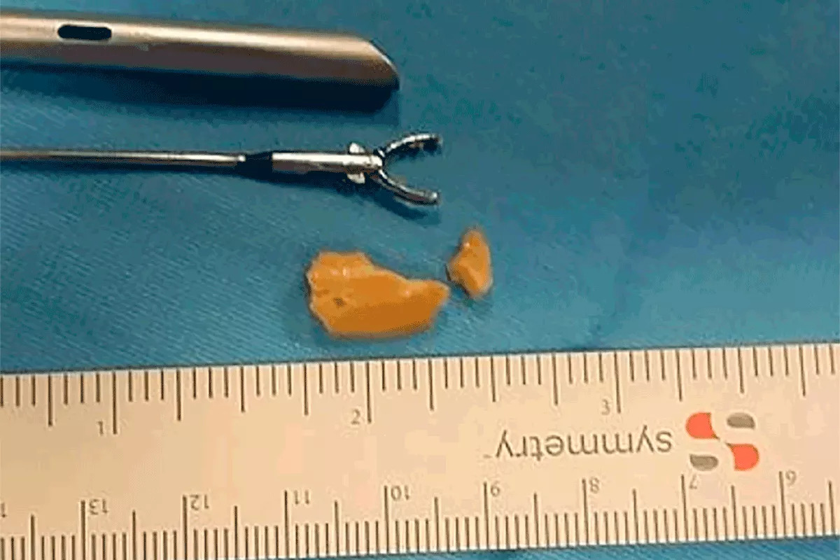 nina avellana bronquios