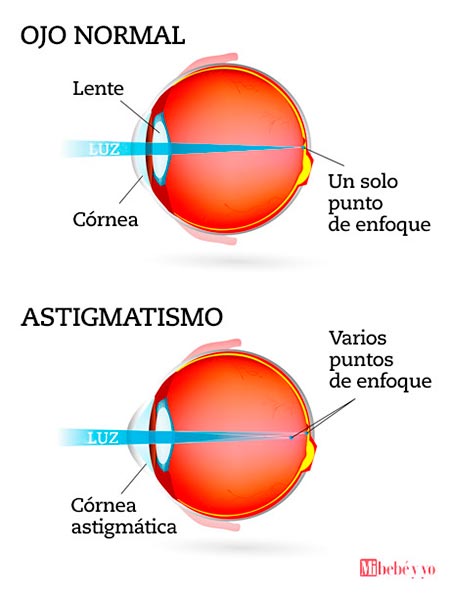 astigmatismo info