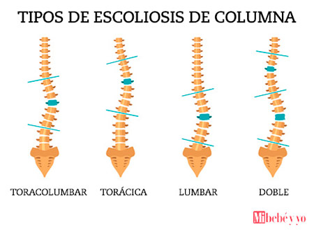 escoliosis info
