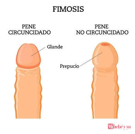 infografia fimosis