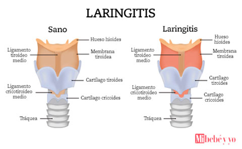 laringitis info