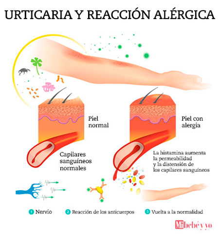 reaccion alergica info