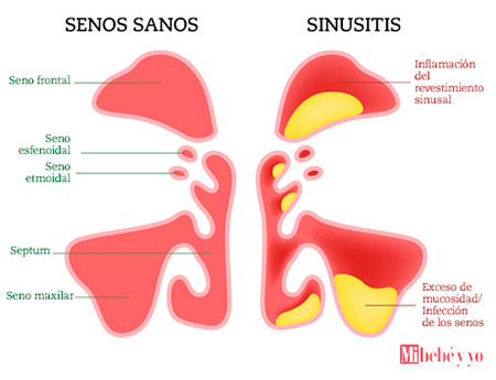 sinusitis infografia