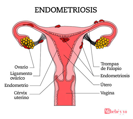 endometriosis infografia