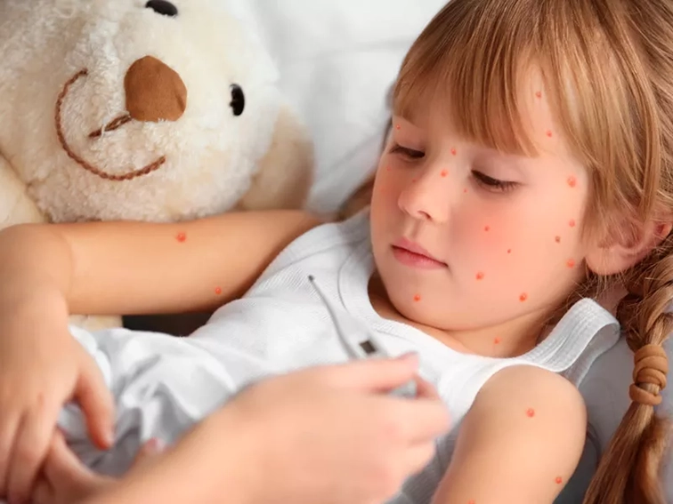 Varicela en niños: síntomas, contagio, riesgos y tratamientos