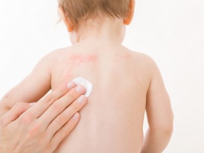 Mother,Fingers,Applying,White,Medical,Ointment,On,Infant,Bare,Back